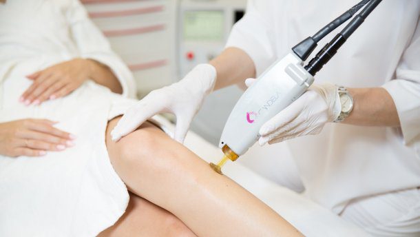 лазерная эпиляция